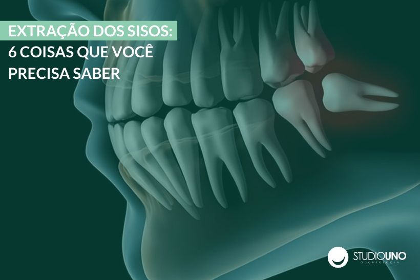 Invisalign em Brasília: melhore seu sorriso com o aparelho
